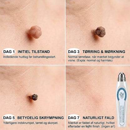 Rollerball™ Serum mod vorter og hudforandringer